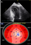 Echo Case: A 71 Year-Old Woman Presenting with Abdominal Pain and Dyspnea